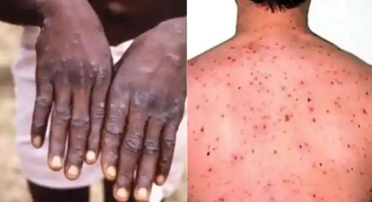 Monkeypox Virus