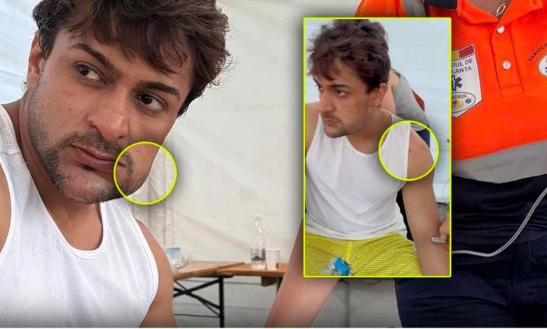 Khatron ke khiladi 14: Shaleen Bhanot became the victim of 200 scorpions! The map of the face got spoiled