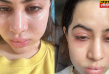 Latest Entertainment News: Urfi Javed's face is in a bad state, people got scared after seeing it