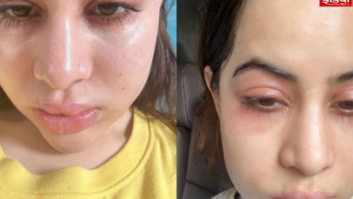 Latest Entertainment News: Urfi Javed's face is in a bad state, people got scared after seeing it