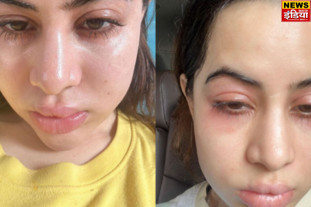 Latest Entertainment News: Urfi Javed's face is in a bad state, people got scared after seeing it