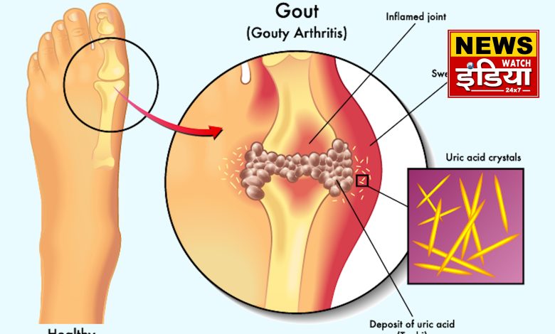 Danger of high uric acid, include these things in your diet and get relief