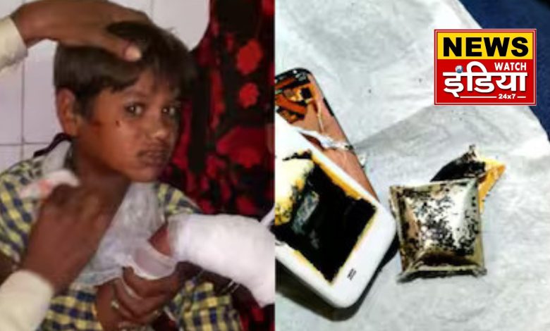 In Chhatarpur, a mobile phone exploded in the hand of a 10-year-old child, the accident happened while playing a game; the child is seriously injured