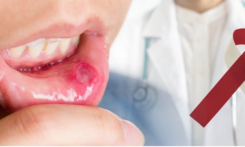 Oral Cancer: Shocking revelation in new study, non-smokers are also becoming victims of this dangerous cancer