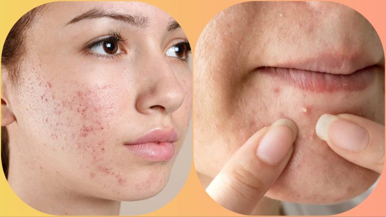 Pimples on the face tell about the health condition! Know what does it mean if pimples are on which part of the face?
