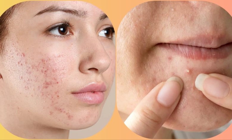 Pimples on the face tell about the health condition! Know what does it mean if pimples are on which part of the face?