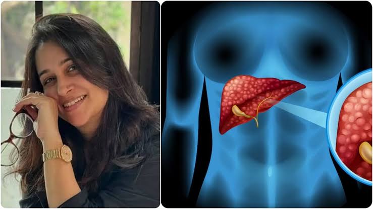 Dipika Kakar Health: Deepika Kakar informed about liver tumor, know the symptoms and precautions of liver cancer