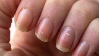 White spots on nails, is it a sign of any serious disease? Know the reason and solution