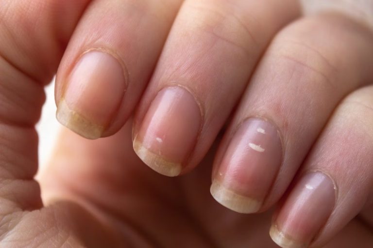 White spots on nails, is it a sign of any serious disease? Know the reason and solution