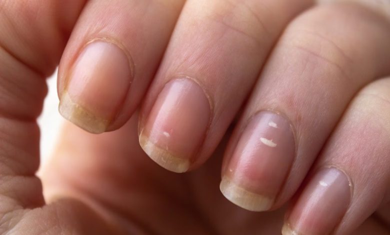 White spots on nails, is it a sign of any serious disease? Know the reason and solution