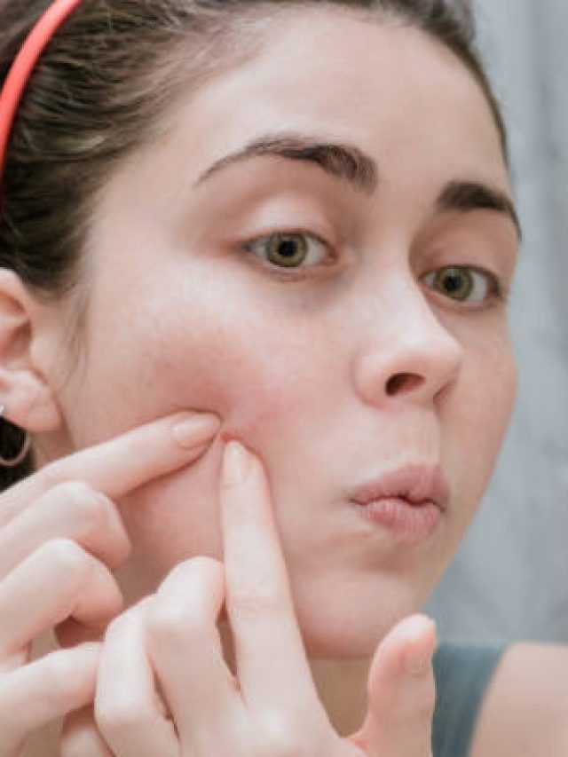 चेहरा बन गया है पिंपल्स का घर? मानसून में ऐसे रखें खास ख्याल